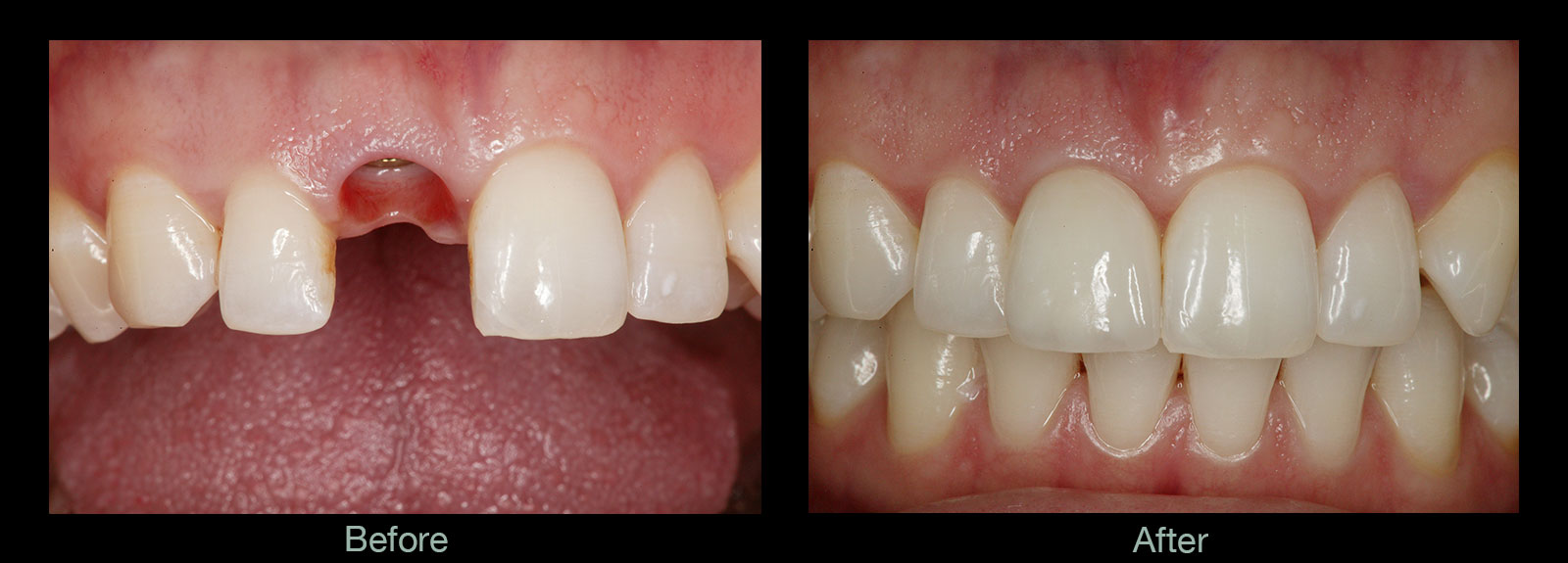 Implant-before-and-after